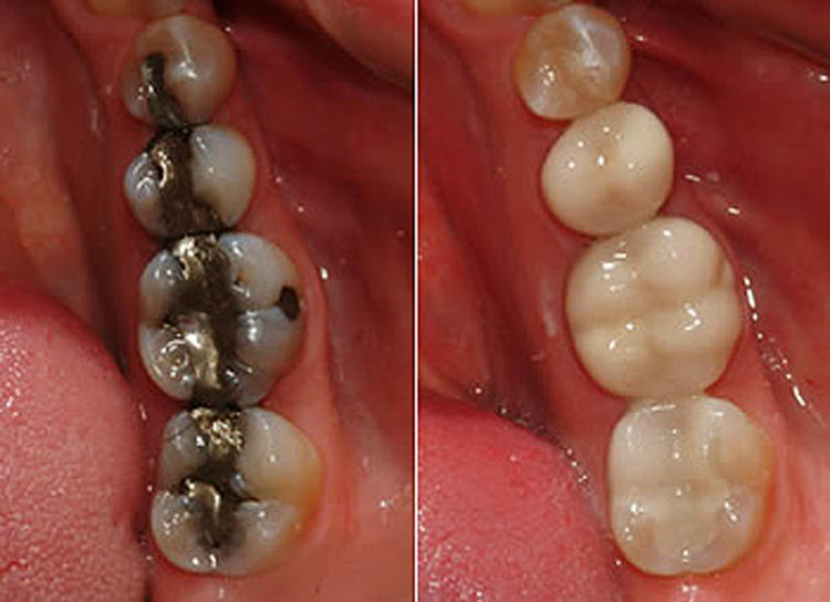 Conservatieve tandheelkunde – Restauratieve behandelingen - Alanya Dental Center