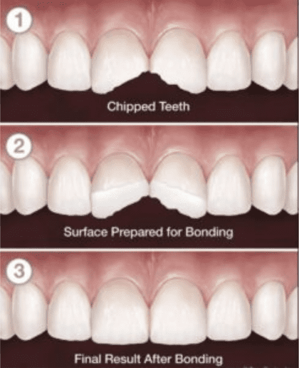 Tandheelkundige composiet bonding - Alanya Dental Center