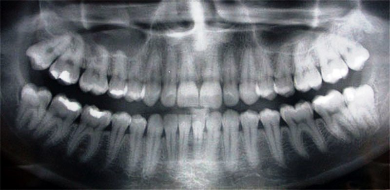 Orale radiologie - Alanya Dental Center