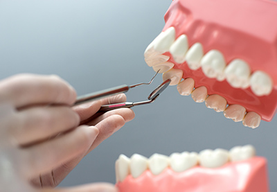 Composiet tandvulling Alanya