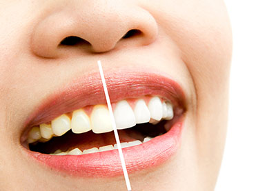 Laser tanden bleken en consult - Alanya Dental Center Tandheelkundige Kliniek