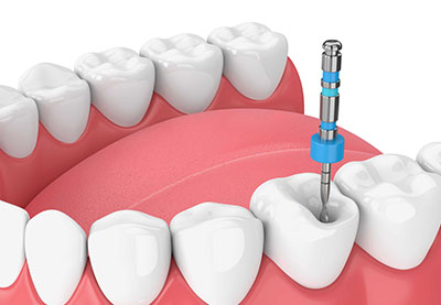 Geïnfecteerde wortelkanaalbehandeling Antalya Alanya