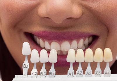 ZIRKONIUM KRONEN facings turkije antalya tandkronen turkije