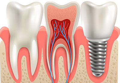 Tand implantaat. Implantaat tandheelkunde en gezondheid tand, gezond implantaat