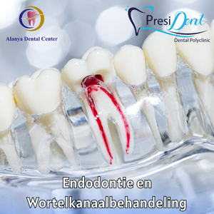 Wortelkanaalbehandeling